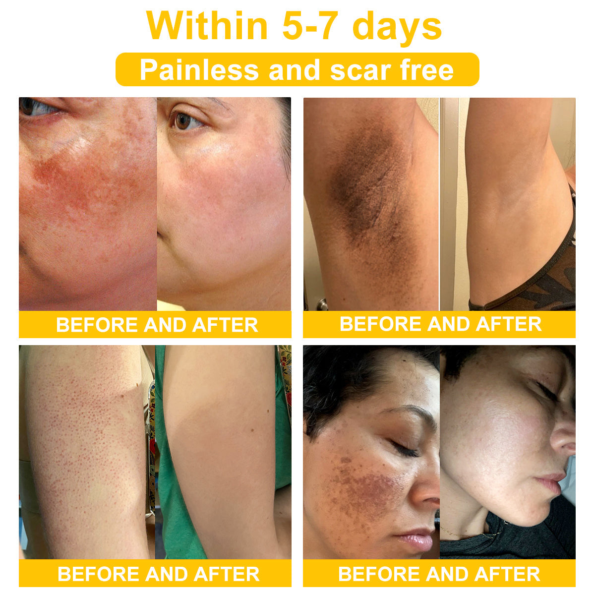 NESLEMY™ Bee Venom Skin Cream(👨⚕AAD Recommended),for Remove Warts, Acne and Scars