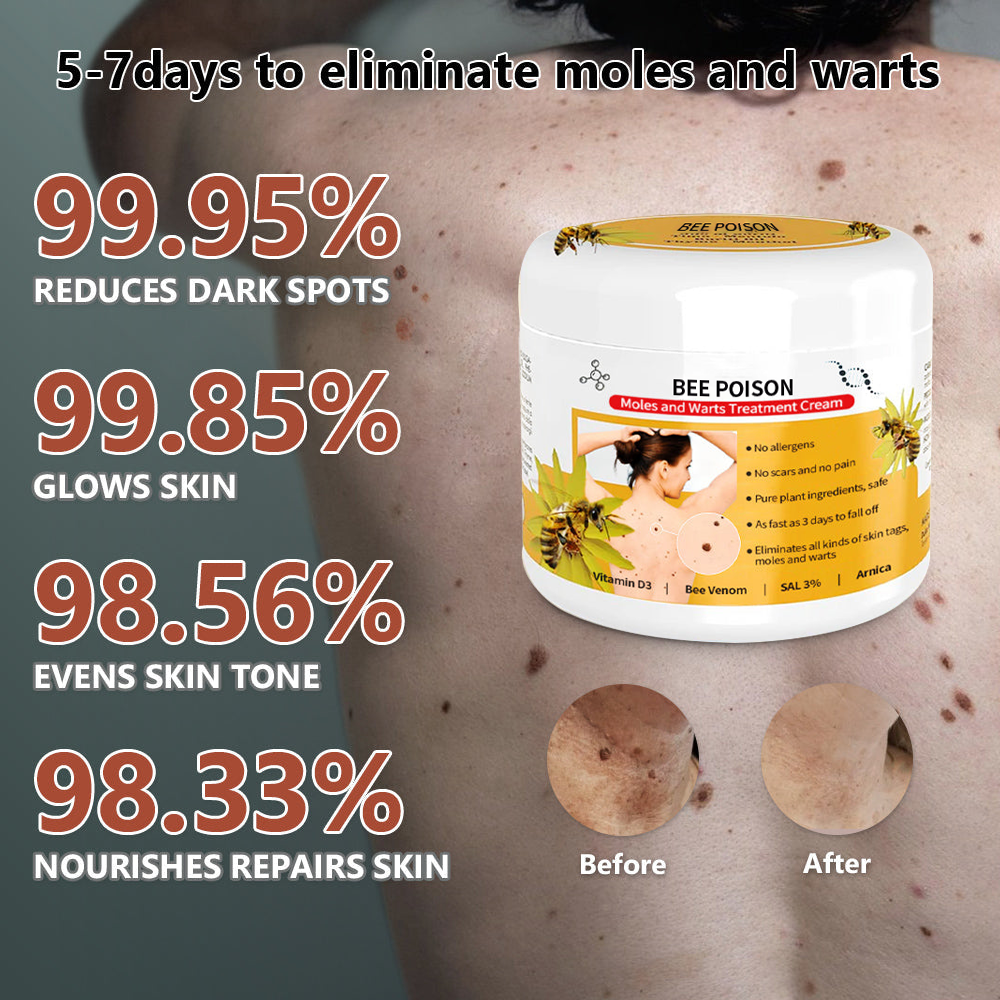 🐝🐝 QIAWI™ BEE POSON MOLE AND WART TREATMENT CREAM(👨⚕AAD RECOMMENDS)