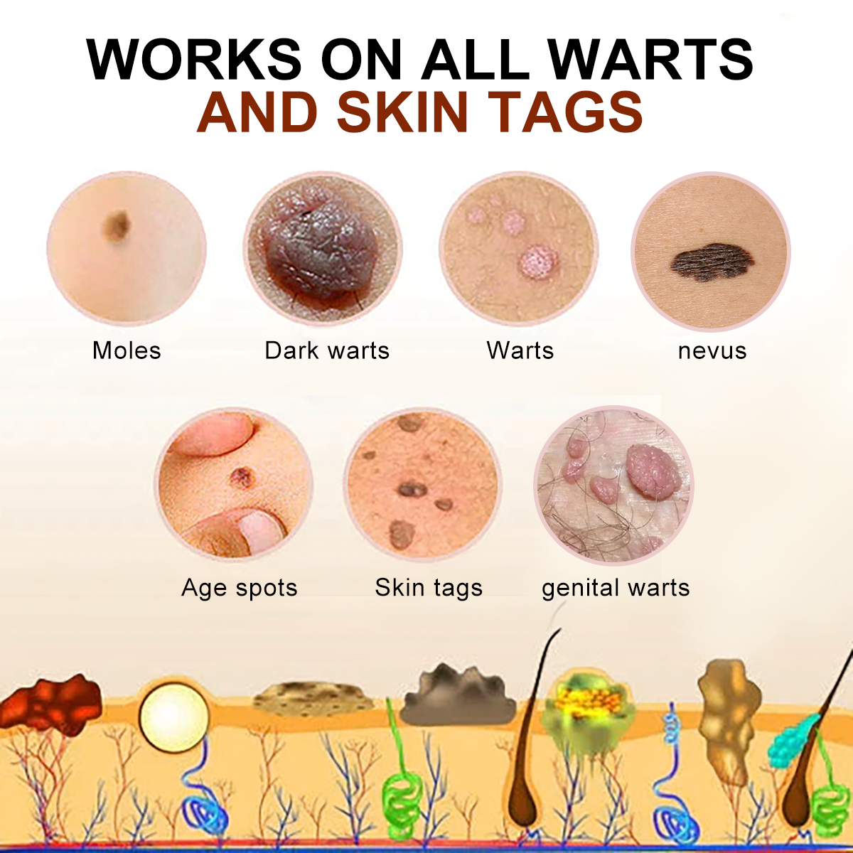 🐝🐝 QIAWI™ BEE POSON MOLE AND WART TREATMENT CREAM(👨⚕AAD RECOMMENDS)