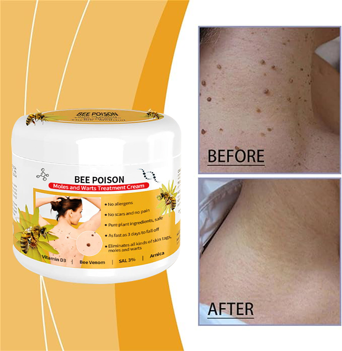 🐝🐝 QIAWI™ BEE POSON MOLE AND WART TREATMENT CREAM(👨⚕AAD RECOMMENDS)