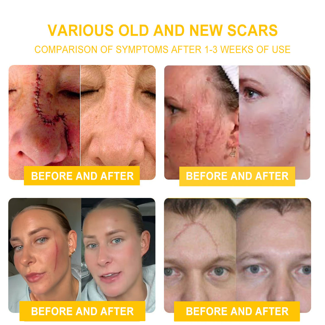 NESLEMY™ Bee Venom Skin Cream(👨⚕AAD Recommended),for Remove Warts, Acne and Scars