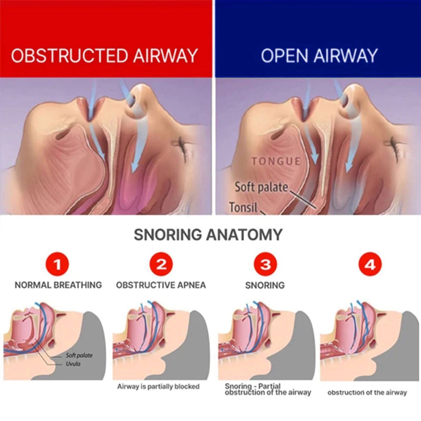 Smileasego⢠Anti-Snoring Guard
