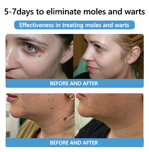 🐝🐝 QIAWI™ BEE POSON MOLE AND WART TREATMENT CREAM(👨⚕AAD RECOMMENDS)