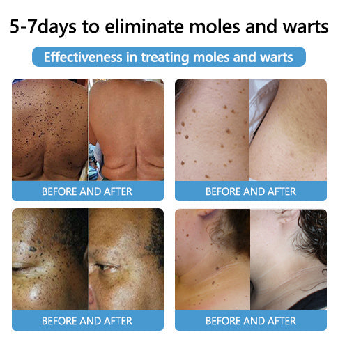 🐝🐝 QIAWI™ BEE POSON MOLE AND WART TREATMENT CREAM(👨⚕AAD RECOMMENDS)