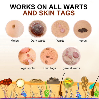 🐝🐝 QIAWI™  BEE POSON MOLE AND WART TREATMENT CREAM(👨‍⚕AAD RECOMMENDS)