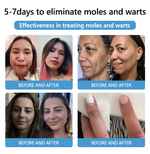 🐝🐝 QIAWI™  BEE POSON MOLE AND WART TREATMENT CREAM(👨‍⚕AAD RECOMMENDS)