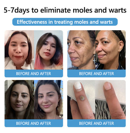 🐝🐝 QIAWI™  BEE POSON MOLE AND WART TREATMENT CREAM(👨‍⚕AAD RECOMMENDS)