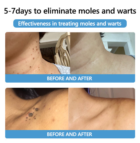 🐝🐝 QIAWI™  BEE POSON MOLE AND WART TREATMENT CREAM(👨‍⚕AAD RECOMMENDS)